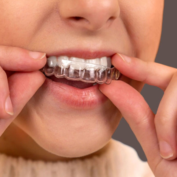 Image of Person Placing Clear Retainers on their Teeth